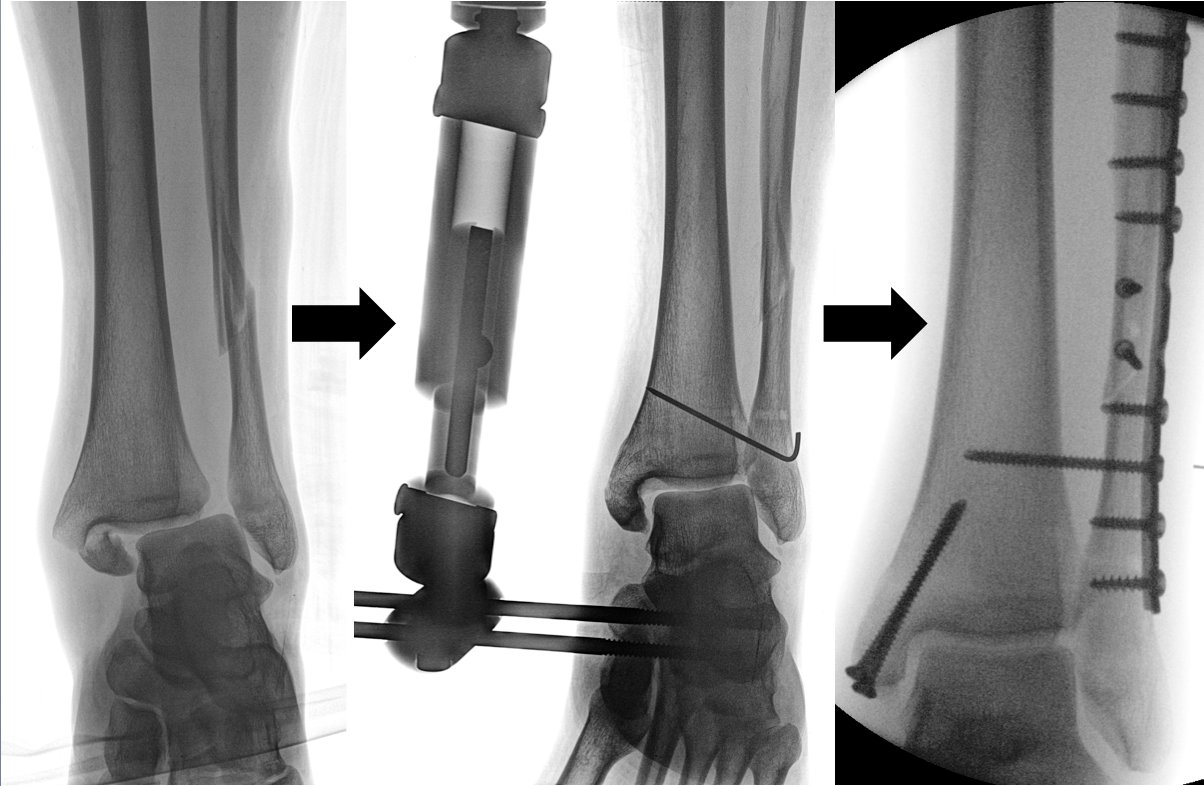 Frattura Scomposta Tibia E Perone Punti Di Invalidit? - remacey